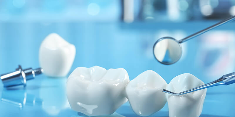 Festsitzender Zahnersatz und Ihre Materialen