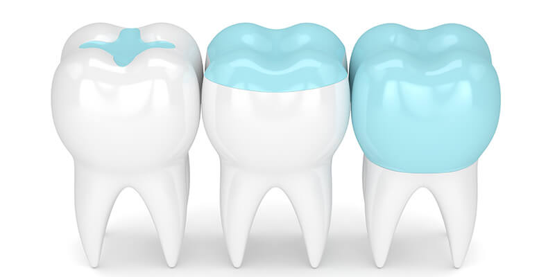 Inlays | Onlays | Overlays