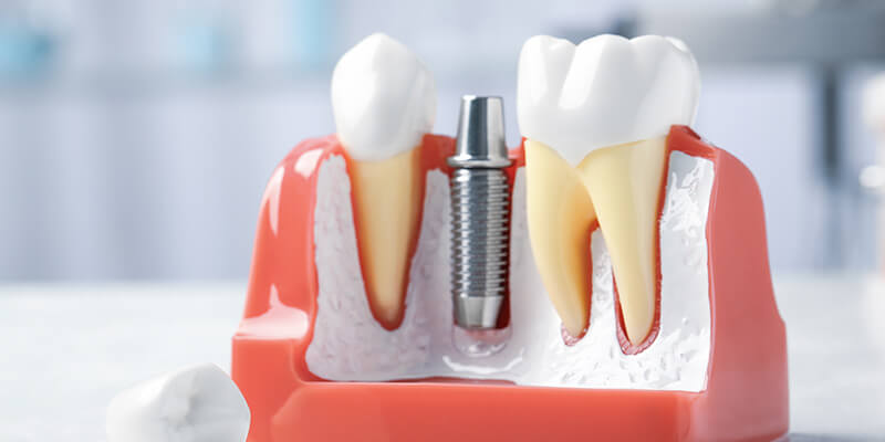 Hochwertige Implantate zum günstigen Preis.