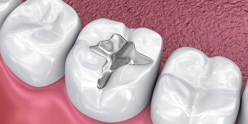 Zahnfüllungen: Arten, Behandlungsablauf und Haltbarkeit